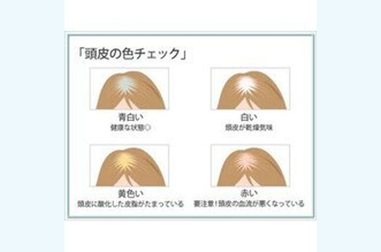 頭皮が赤くなる原因は？その1